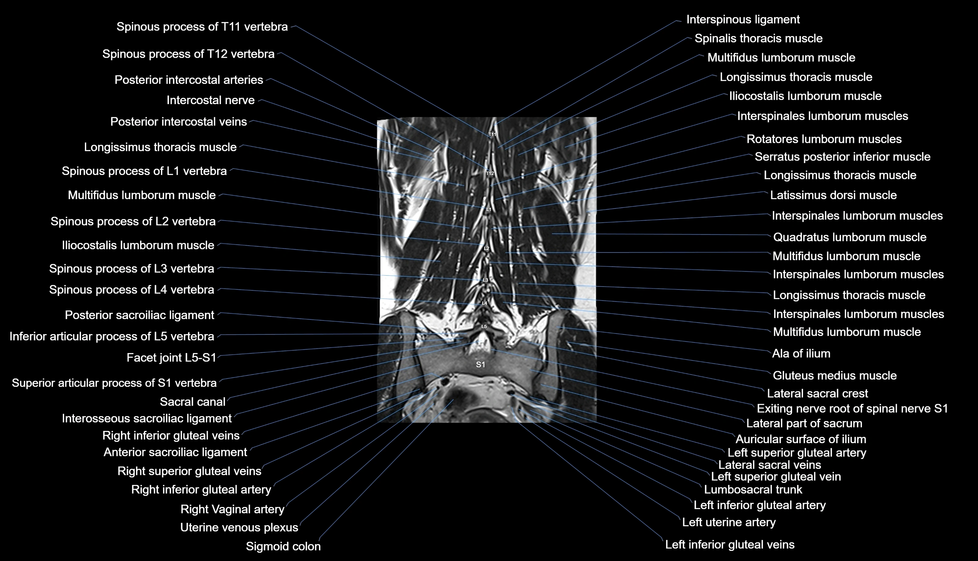 MRI lumbar spine labelled coronal cross sectional anatomy 3T radiology-img-00001-00026.webp